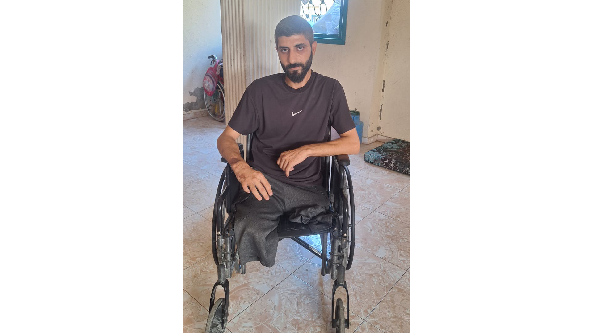 رحلة معاناتي من النزوح والبتر والانتظار